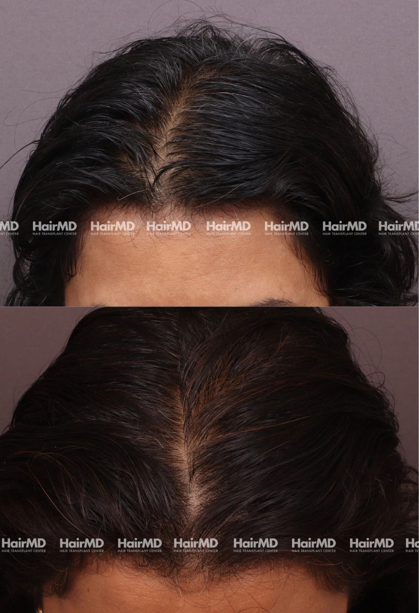 41yrs Nutritional hairloss Results 6 Months Timeline 6 Sessions HairMD Pune