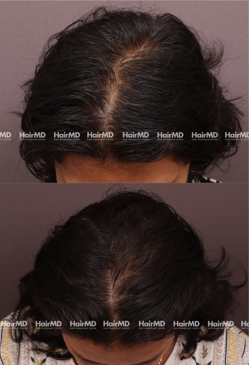 41yrs Nutritional Hairloss Results 6 Months Timeline 6 Sessions HairMD Pune