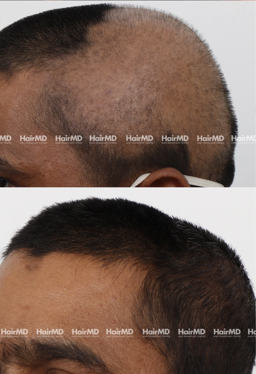 42yrs Alopecia Areata Hairloss Results 6 Months Timeline 7 Sessions HairMD Pune