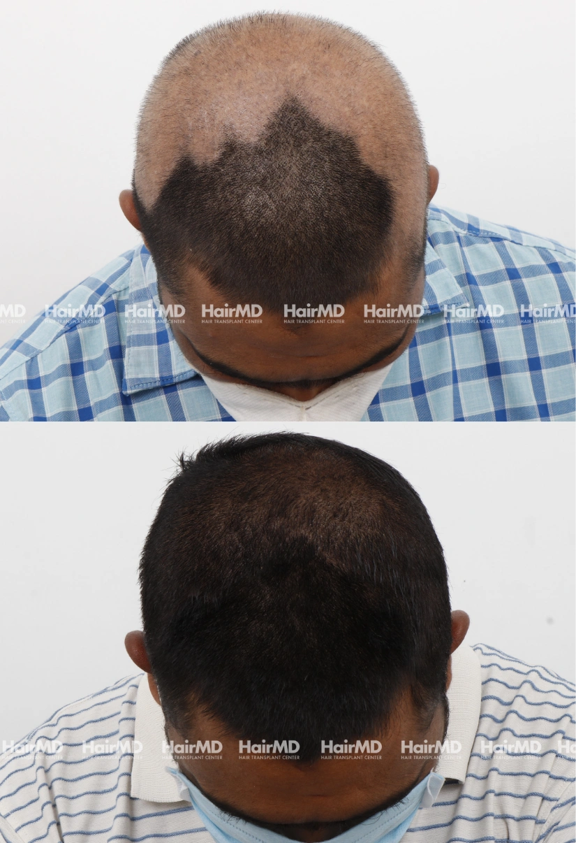 42yrs Alopecia areata Hairloss Results 6 Months Timeline 7 Sessions HairMD Pune