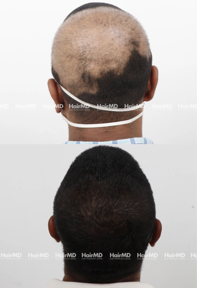 42yrs Alopecia areata Hairloss Results 6 Months Timeline 7 Sessions HairMD Pune