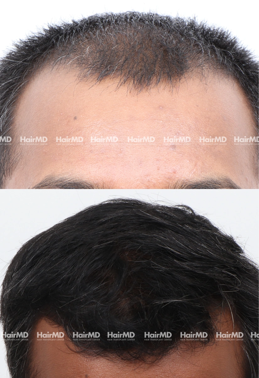 42yrs Nutritional hairloss Results 6 Months Timeline 6 Sessions HairMD Pune