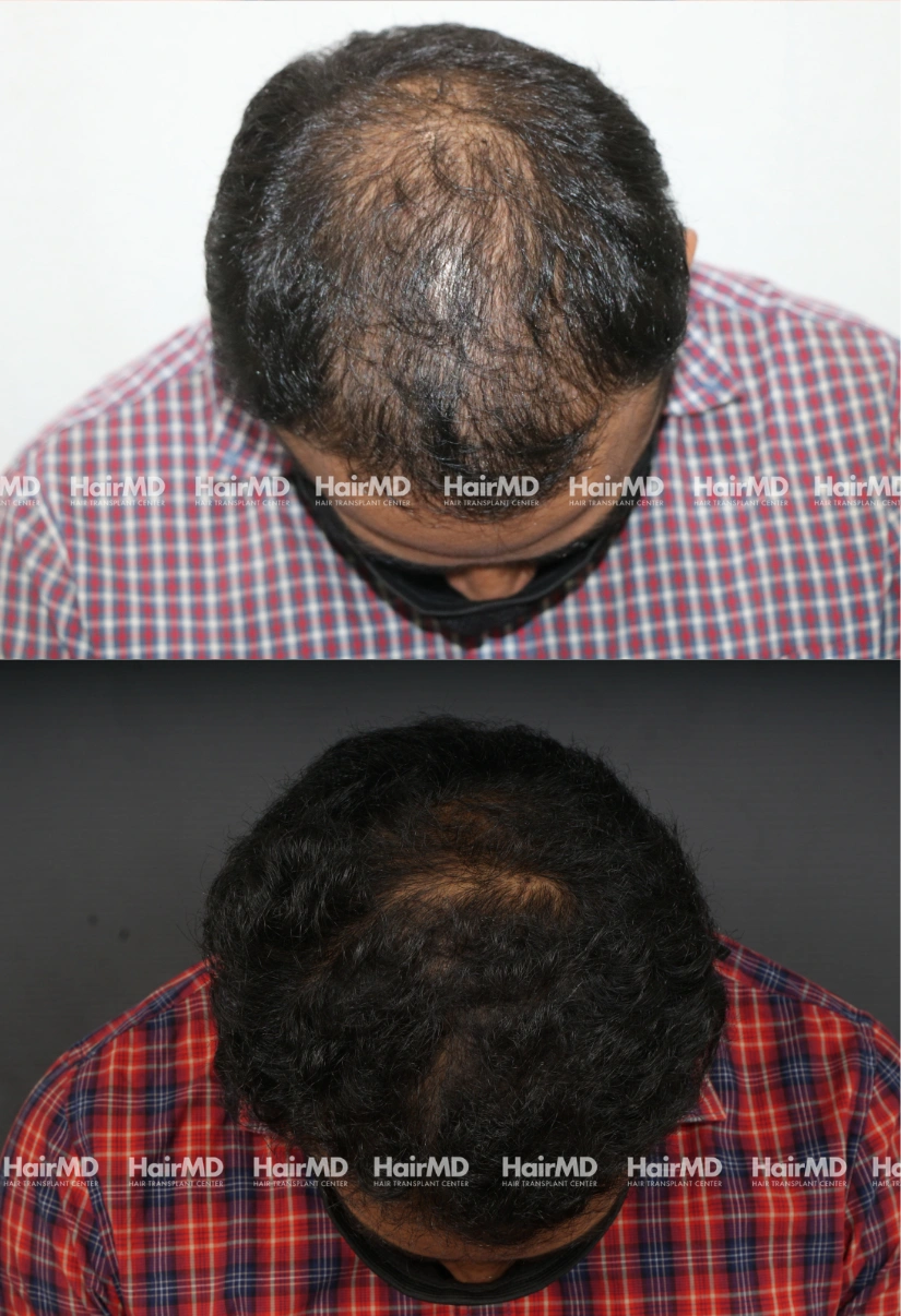 44yrs Baldness Hairloss Results 6 Months Timeline 7 Sessions HairMD Pune