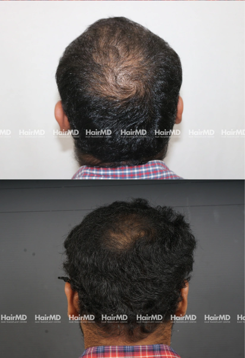 44yrs Baldness Hairloss Results 6 Months Timeline 7 Sessions HairMD Pune