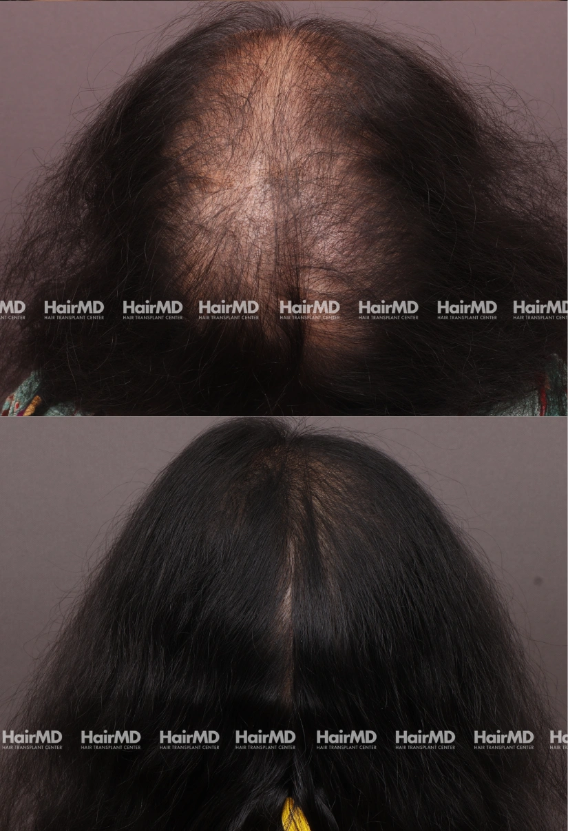 45yrs Female Hairloss Results 6 Months Timeline 8 Sessions HairMD Pune