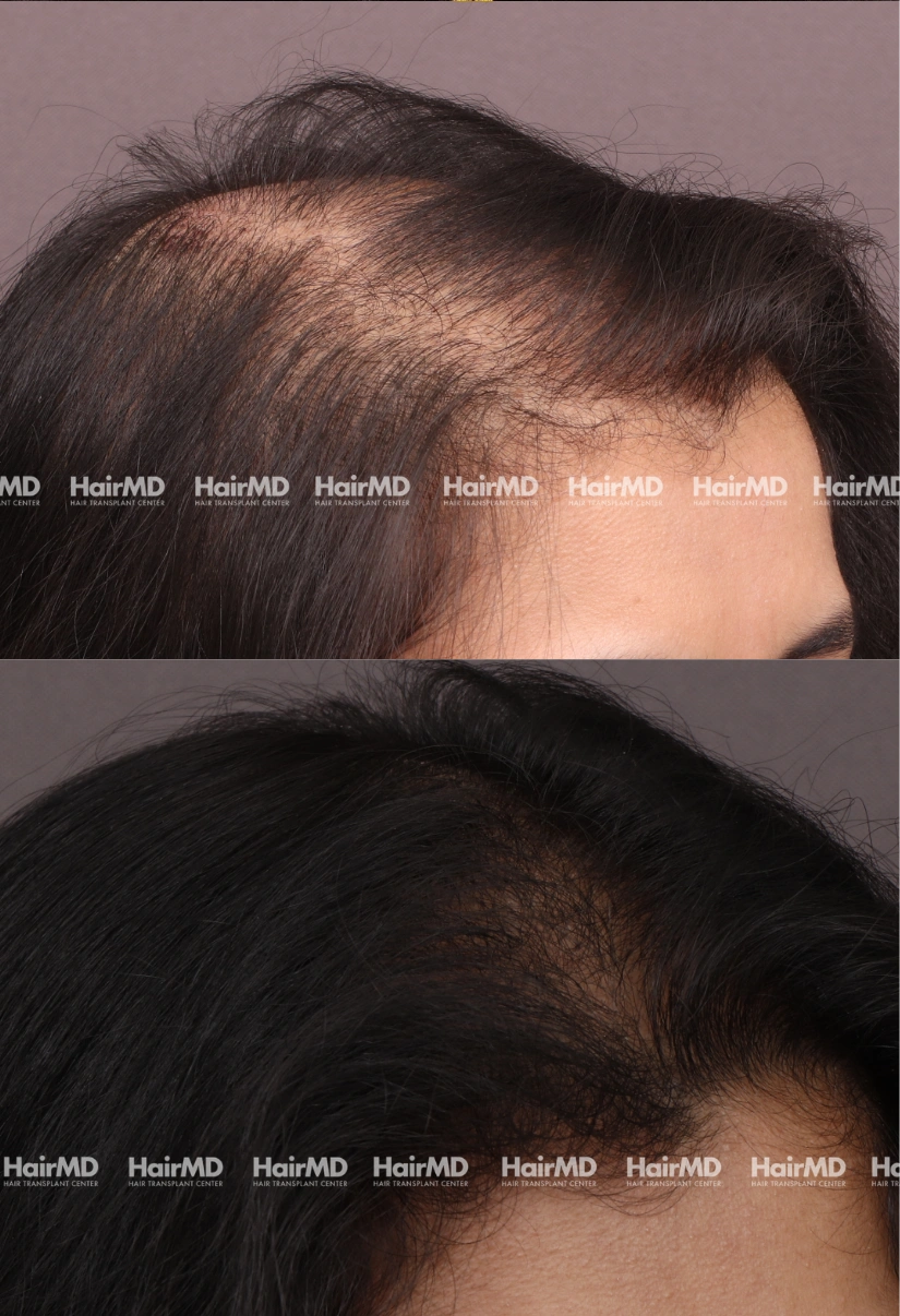 45yrs Female Hairloss Results 6 Months Timeline 8 Sessions HairMD Pune