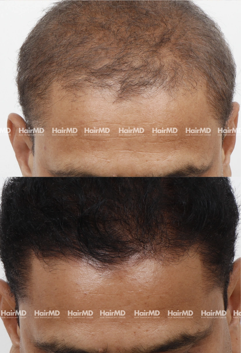 45yrs Nutritional hairloss Results 6 Months Timeline 7 Sessions HairMD Pune