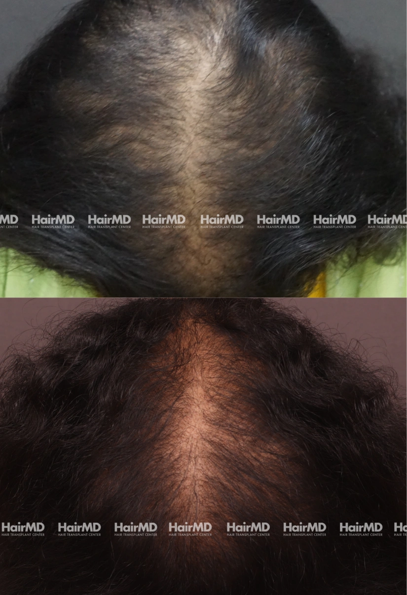 46yrs Female Hairloss Results 6 Months Timeline 8 Sessions HairMD Pune