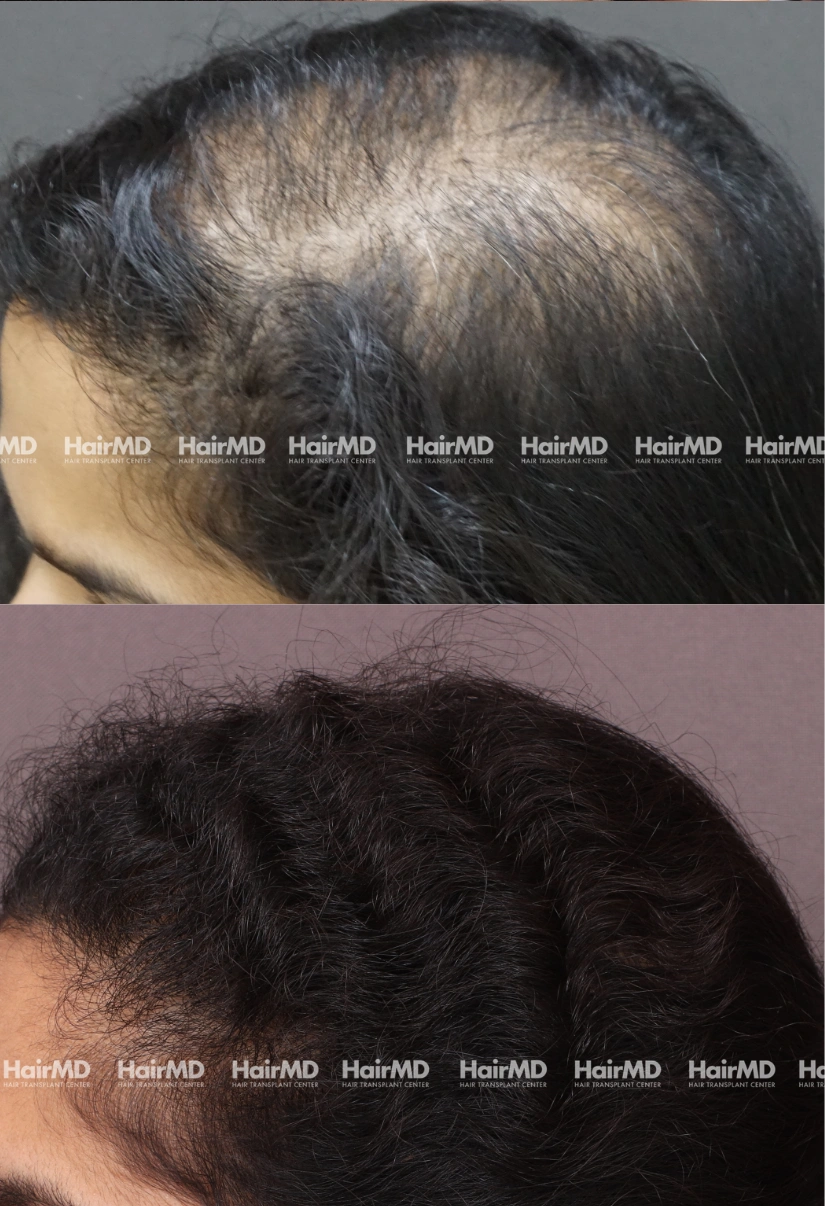 46yrs Female Hairloss Results 6 Months Timeline 8 Sessions HairMD Pune