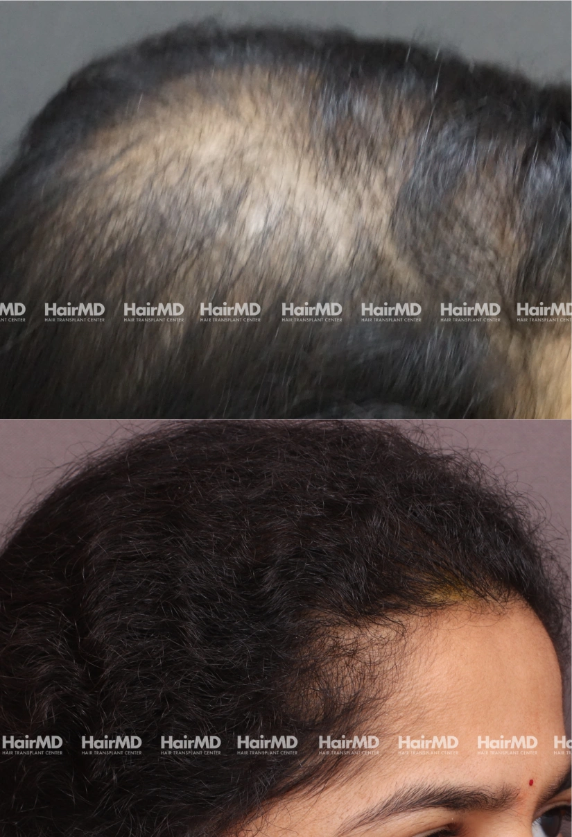 46yrs Female Hairloss Results 6 Months Timeline 8 Sessions HairMD Pune