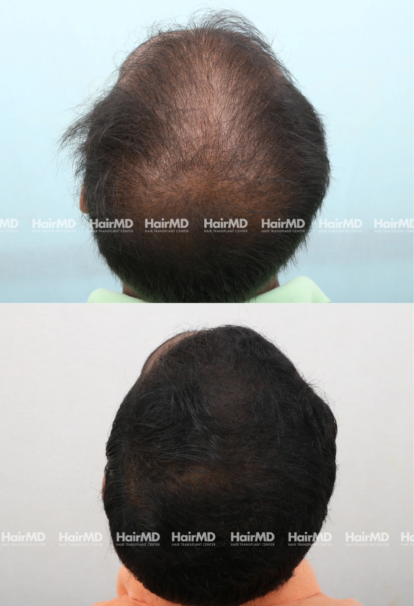 47yrs Baldness Hairloss Results 6 Months Timeline 6 Sessions HairMD Pune