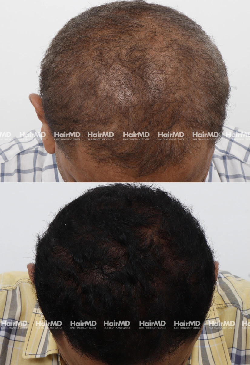 48yrs Nutritional Hairloss Results 6 Months Timeline 6 Sessions HairMD Pune