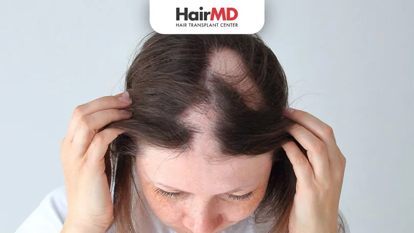 Alopecia Areata Treatment: Patient Testimonials | HairMD