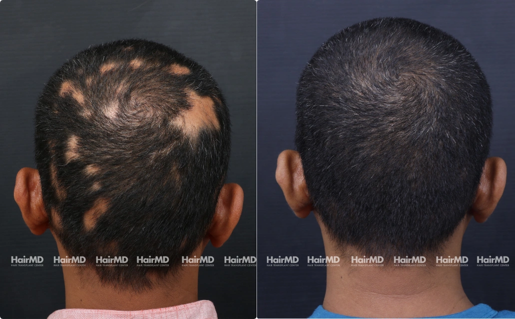 Alopecia areata Results 7 Sessions 6 Months ClearSkin Pune