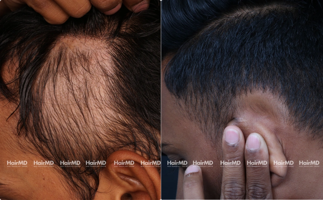 Alopecia areata Results 7 Sessions 6 Months ClearSkin Pune