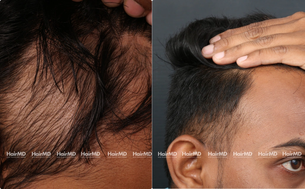 Alopecia areata Results 7 Sessions 6 Months HairMD Pune