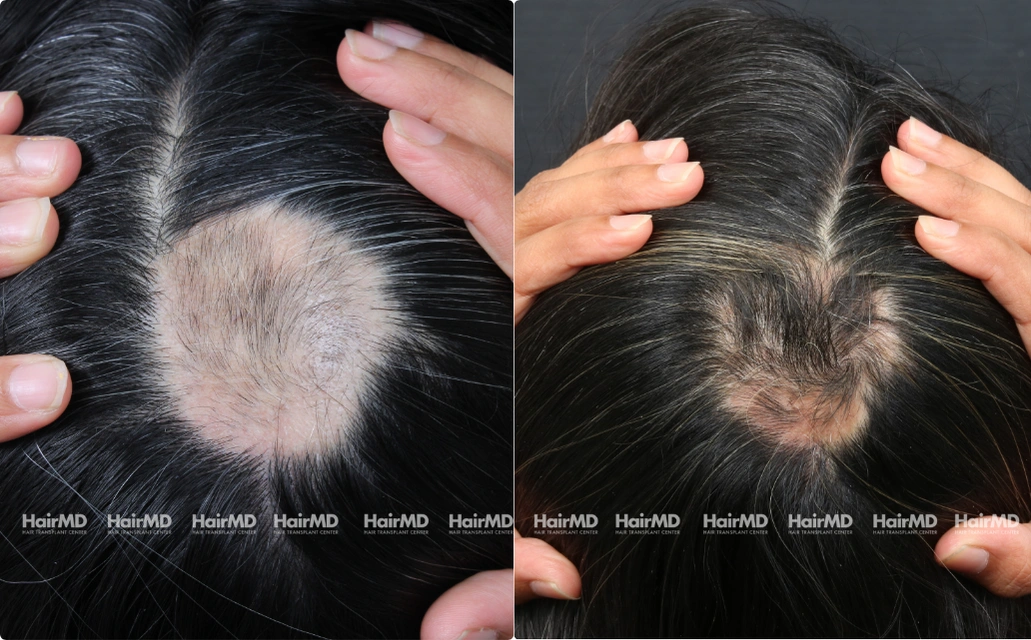 Alopecia areata Results 7 Sessions 6 Months HairMD Pune