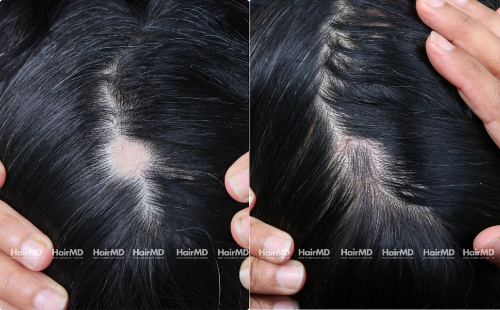 Alopecia areata Results 7 Sessions 6 Months HairMD Pune