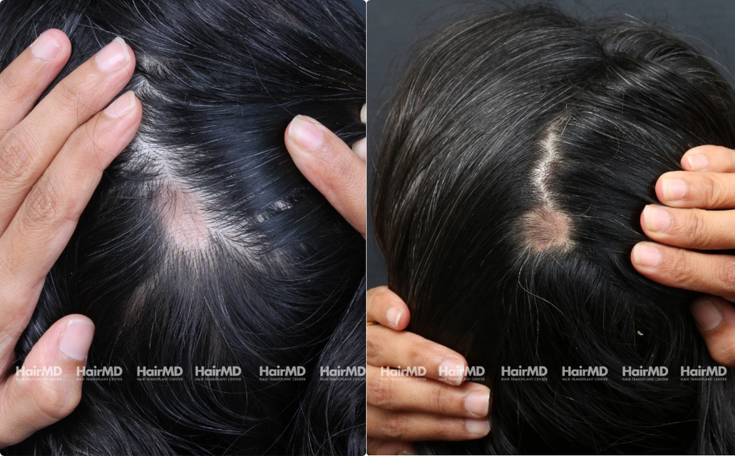 Alopecia areata Results 7 Sessions 6 Months HairMD Pune