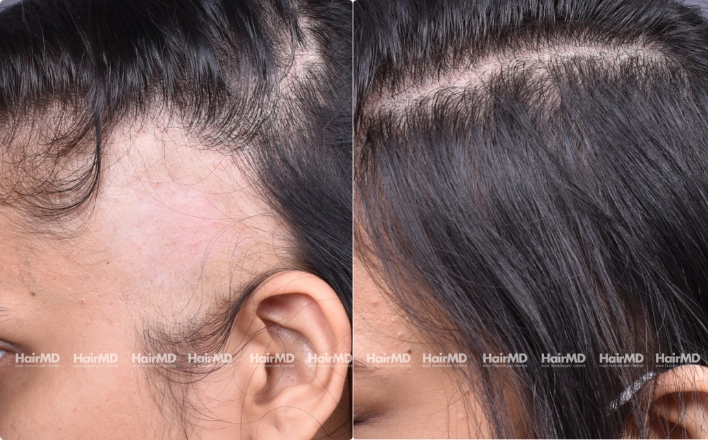 Alopecia areata Results 7 Sessions 6 Months HairMD Pune