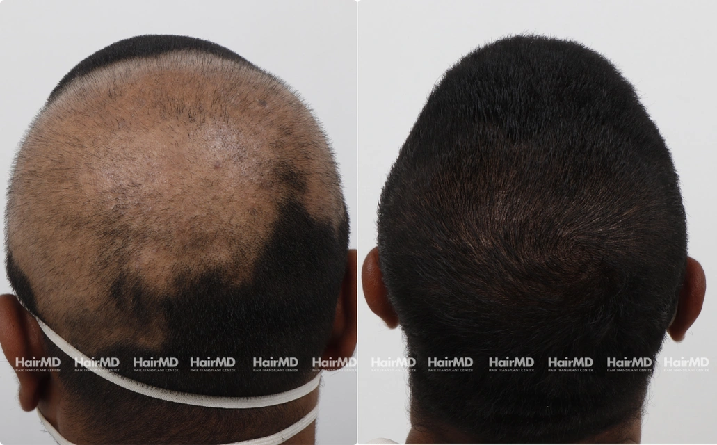 Alopecia areata Results 7 Sessions 6 Months HairMD Pune