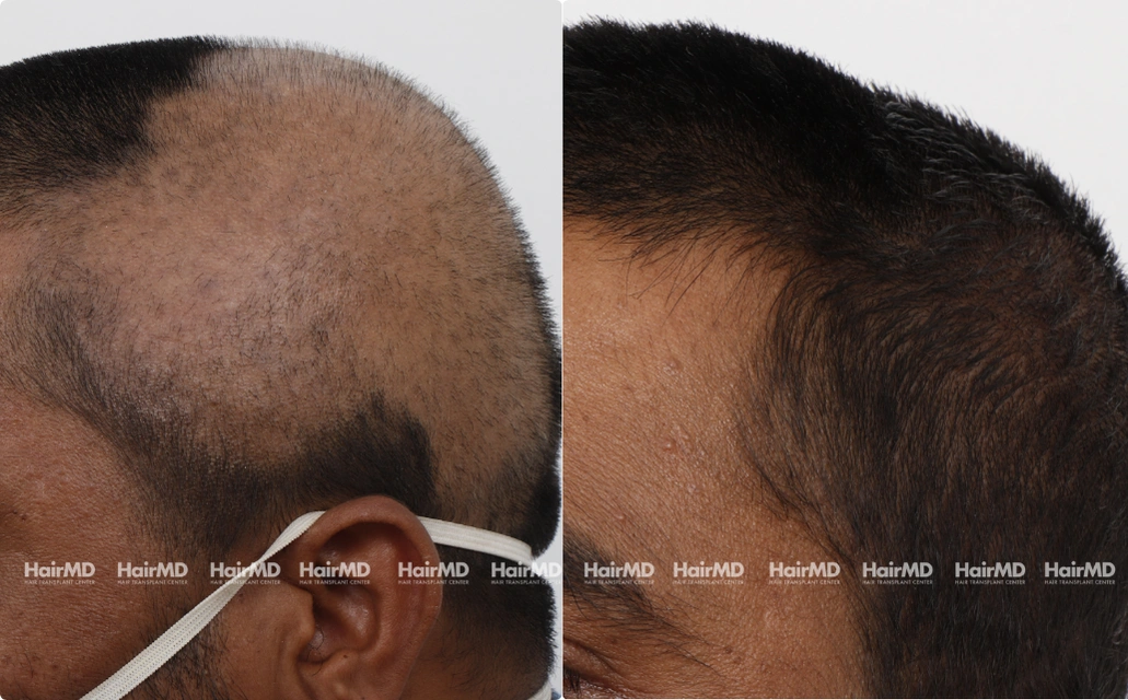 Alopecia areata Results 7 Sessions 6 Months HairMD Pune