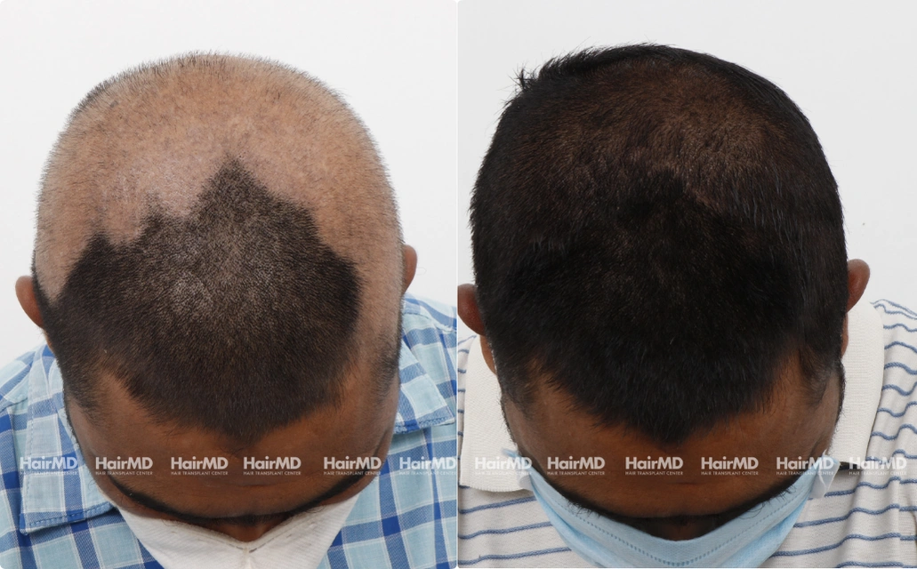 Alopecia areata Results 7 Sessions 6 Months HairMD Pune