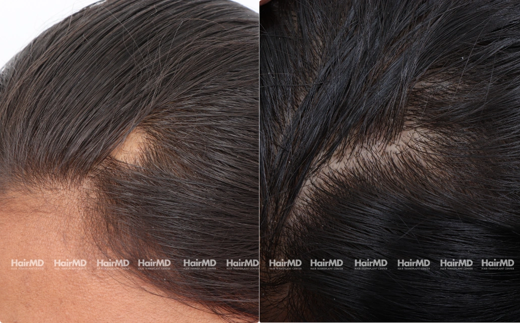 Alopecia areata Results 7 Sessions 6 Months HairMD Pune