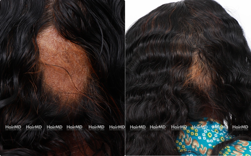 Alopecia areata Results 7 Sessions 6 Months HairMD Pune