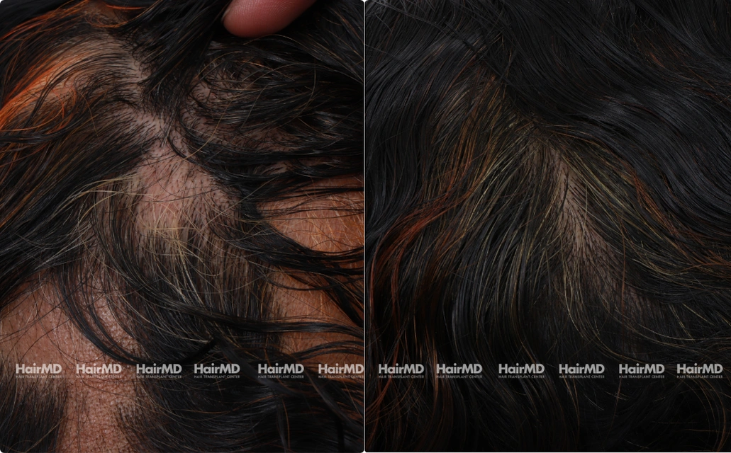 Alopecia areata Results 7 Sessions 6 Months HairMD Pune