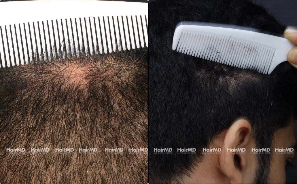 Alopecia areata Results 7 Sessions 6 Months HairMD Pune