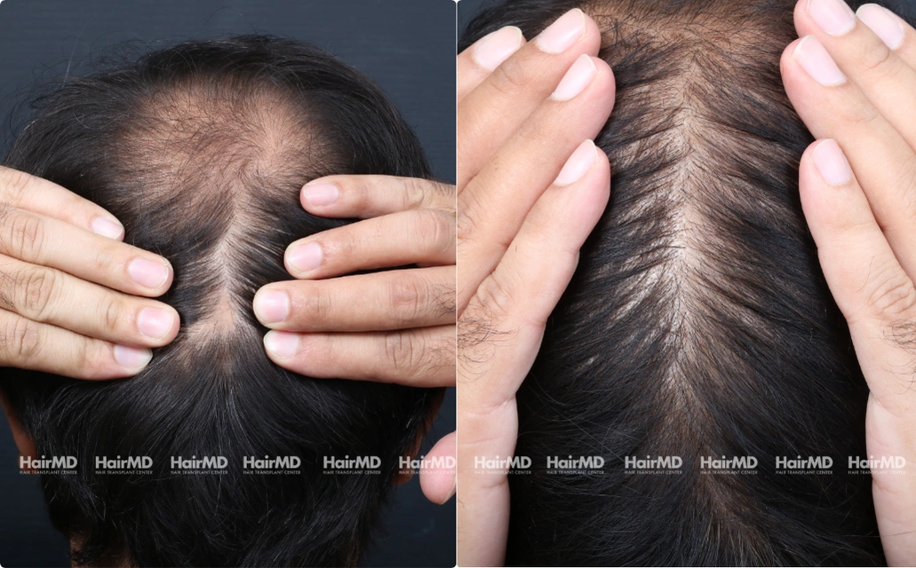 Alopecia areata Results 7 Sessions 6 Months ClearSkin Pune