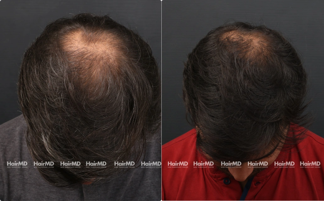 Alopecia areata Results 7 Sessions 6 Months HairMD Pune