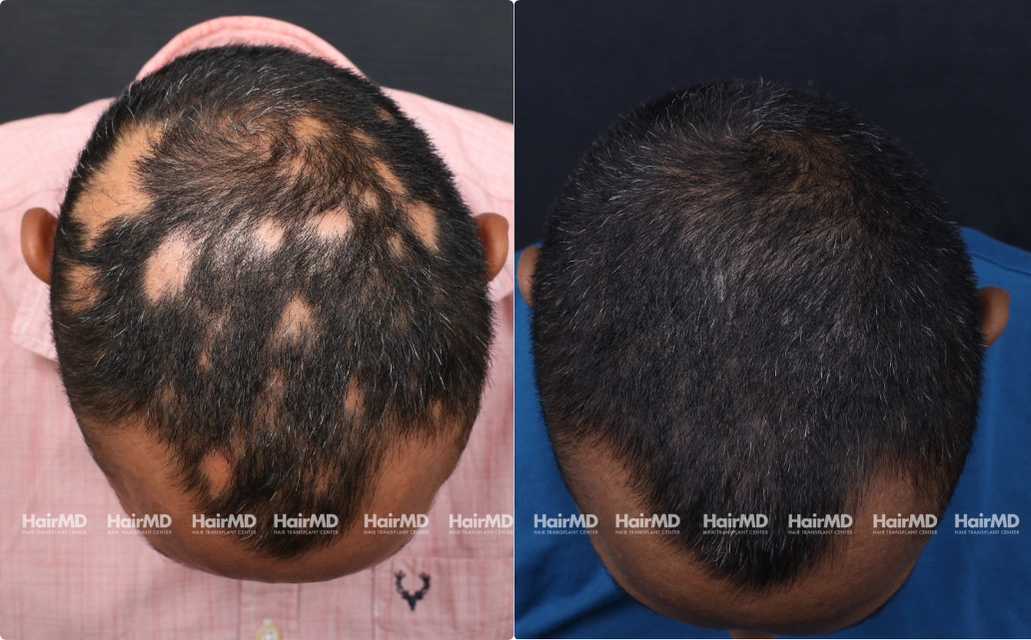 Alopecia areata Results 7 Sessions 6 Months ClearSkin Pune