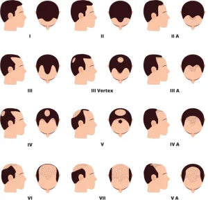 Baldness Level and the Number of Grafts