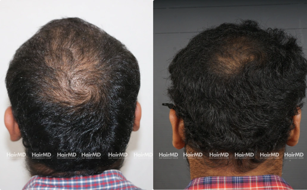 Baldness Results 7 Sessions 6 Months HairMD Pune