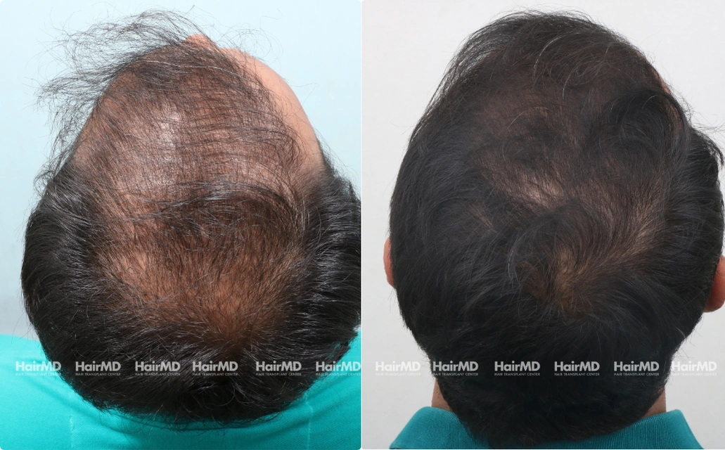 Baldness Results 7 Sessions 6 Months HairMD Pune