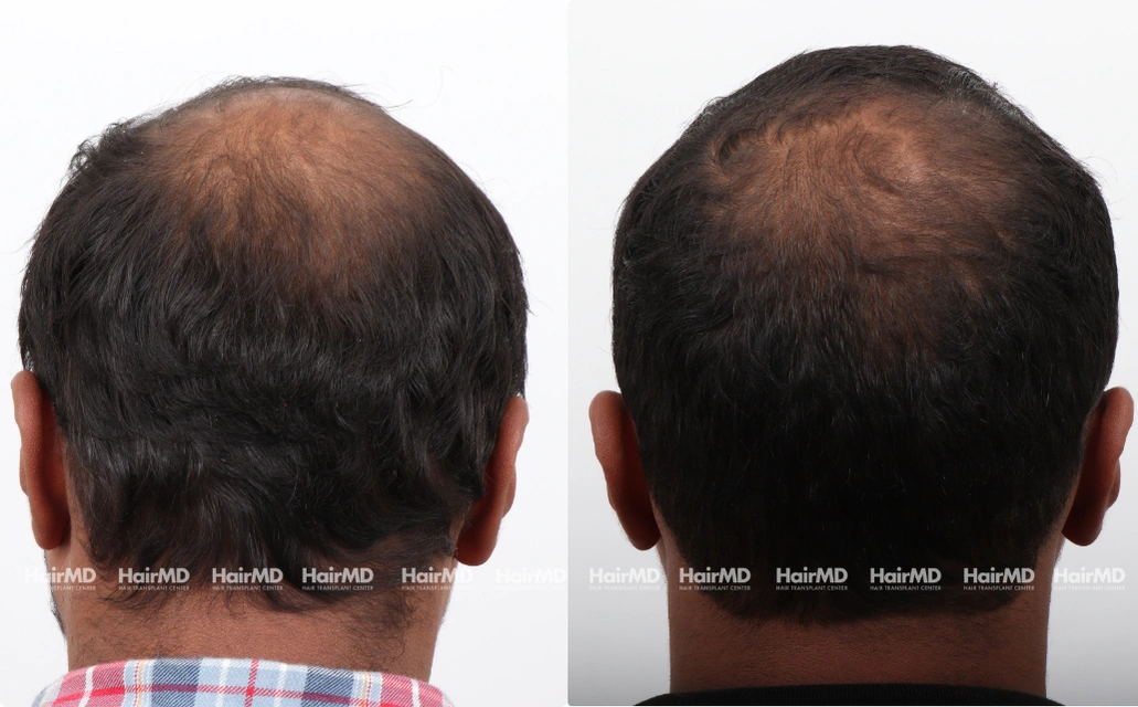 Baldness Results 7 Sessions 6 Months HairMD Pune