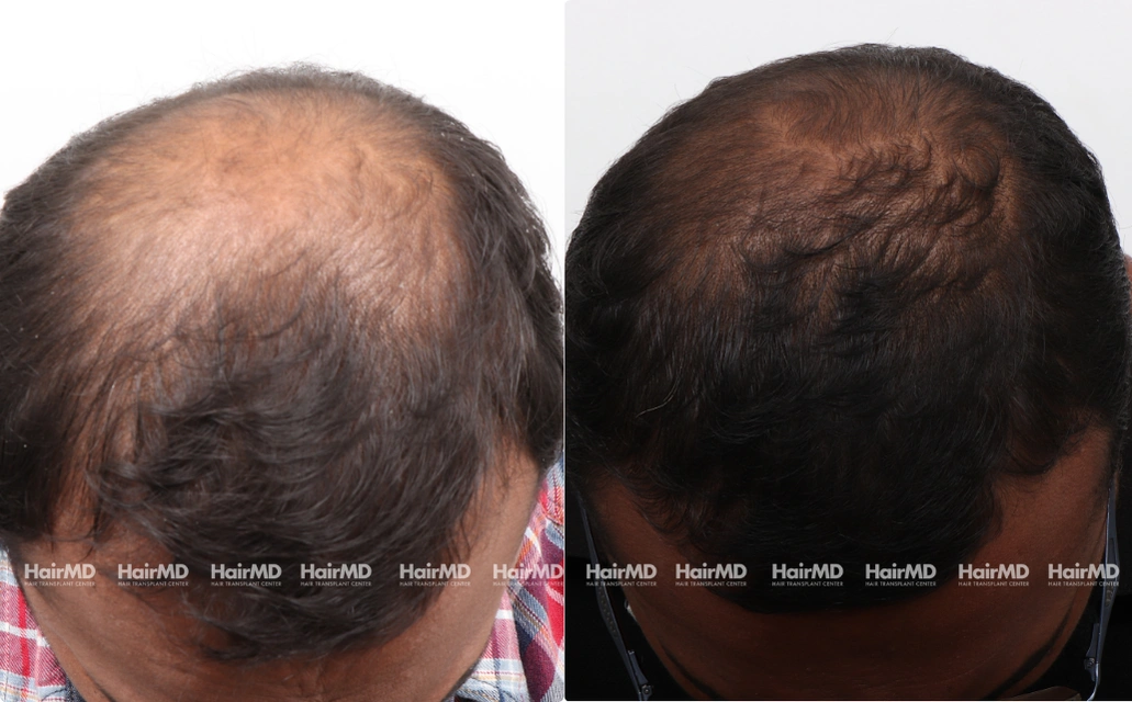 Baldness Results 7 Sessions 6 Months HairMD Pune