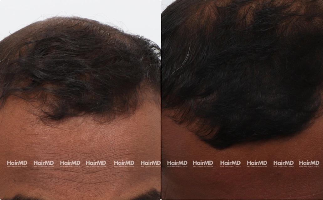 Baldness Results 7 Sessions 6 Months HairMD Pune