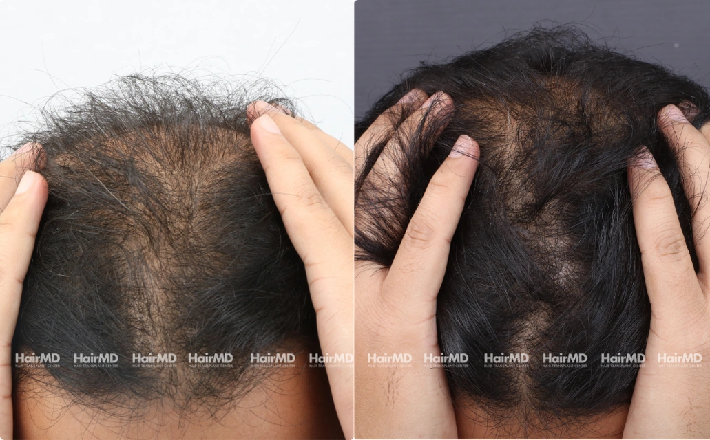 Baldness Results 7 Sessions 6 Months ClearSkin Pune