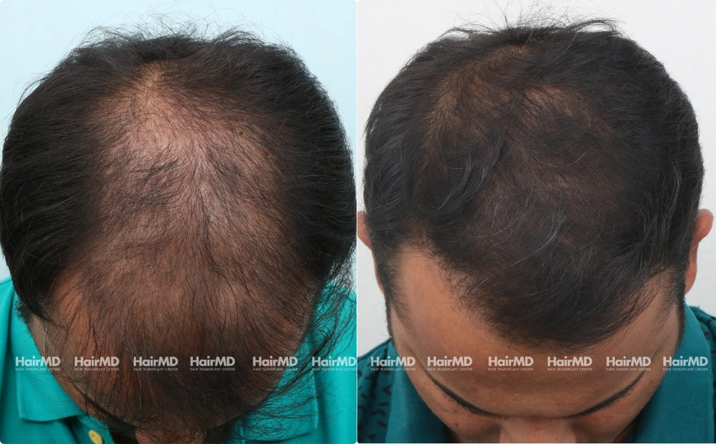 Baldness Results 7 Sessions 6 Months HairMD Pune 2