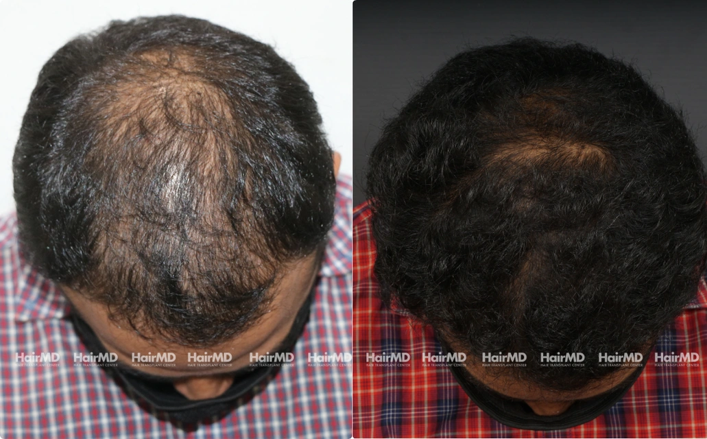 Baldness Results 7 Sessions 6 Months HairMD Pune 3