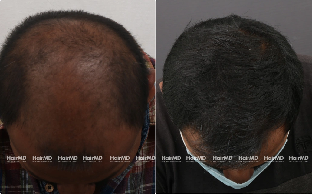 Baldness Results 7 Sessions 6 Months HairMD Pune 4