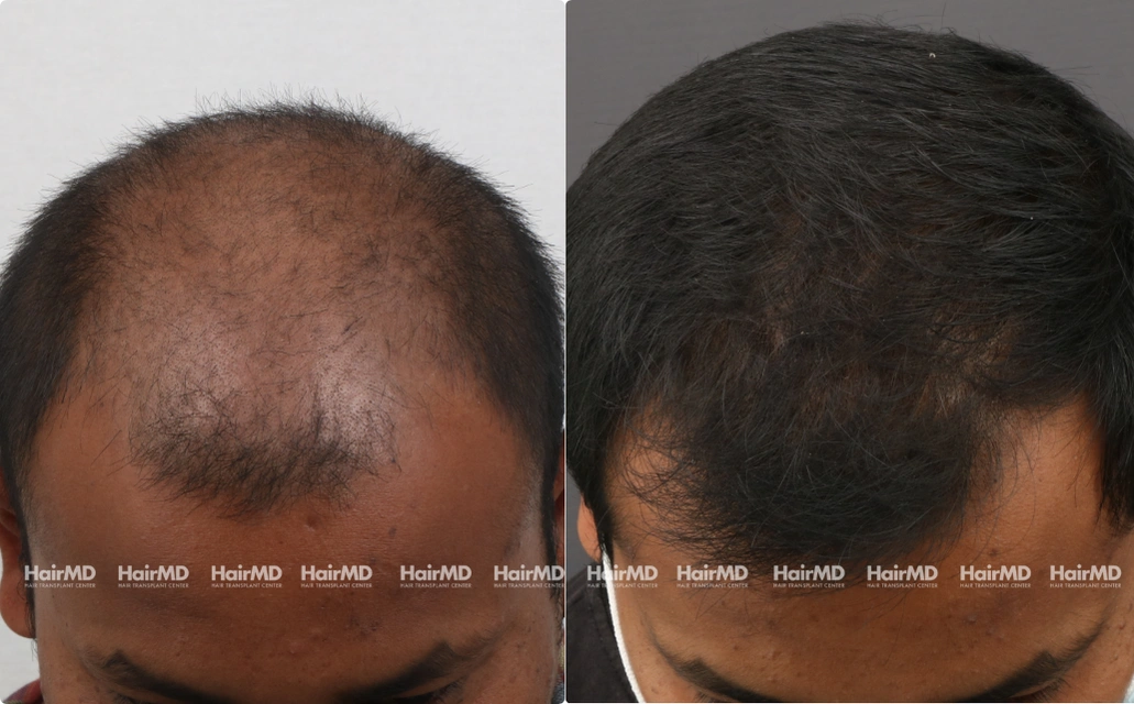 Baldness Results 7 Sessions 6 Months HairMD Pune 5