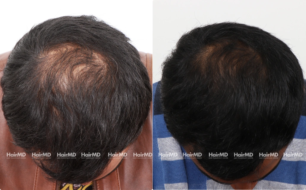 Baldness Results 7 Sessions 6 Months HairMD Pune