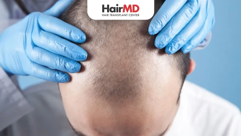 Can-FUE-hair-transplant--be-painful-HairMD-Pune