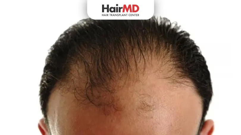 Can-minoxidil-work-on-frontal-baldness-HairMD-Pune