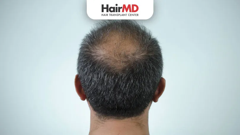 Does DHT cause hair loss?