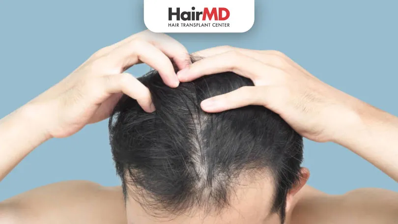 Does-Minoxidil-Cause-Hair-Loss-HairMD-Pune